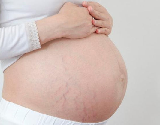 Stretch Mark 101