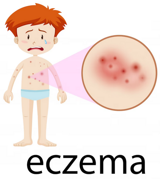 Caring for Children with Atopic Dermatitis (Eczezma)