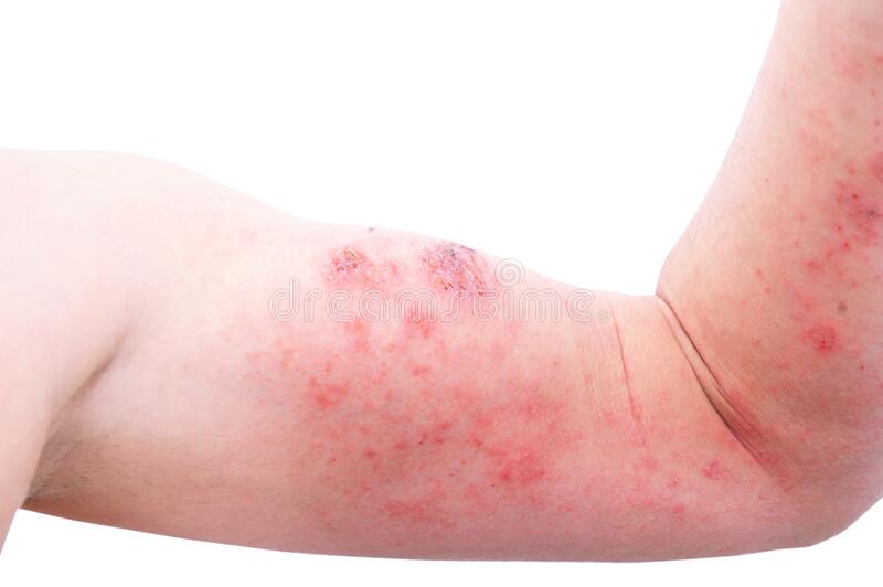 Eczema flare-up