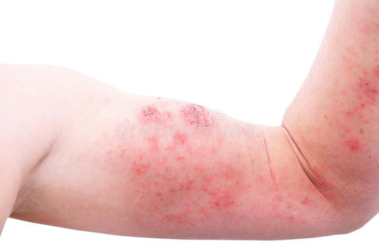 Eczema flare-up