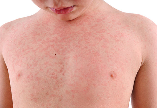 Eczema 101