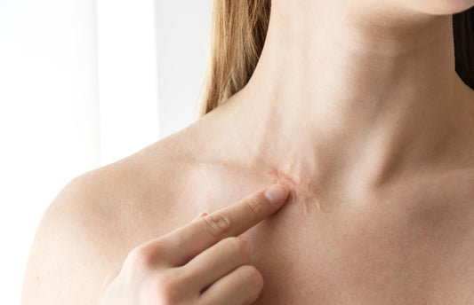 Silicone Scar Gel Vs. Salicylic Acid