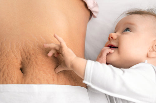 Risk Factors for Stretch Marks
