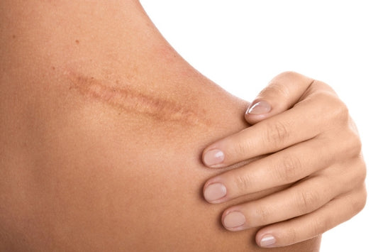 Benefits of early use of ScarMD