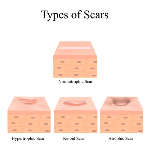 Scar 101: How Are Scars Formed?