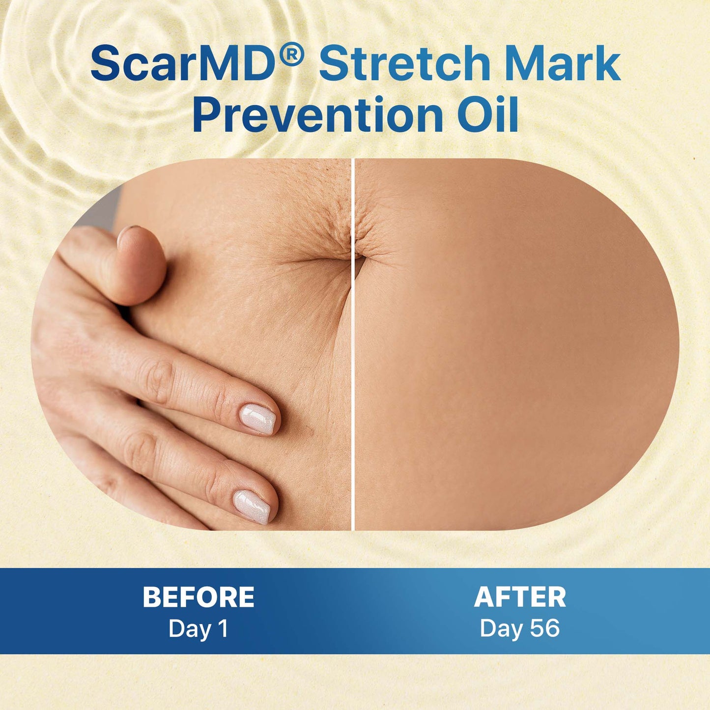 Stretch Mark Prevention Oil